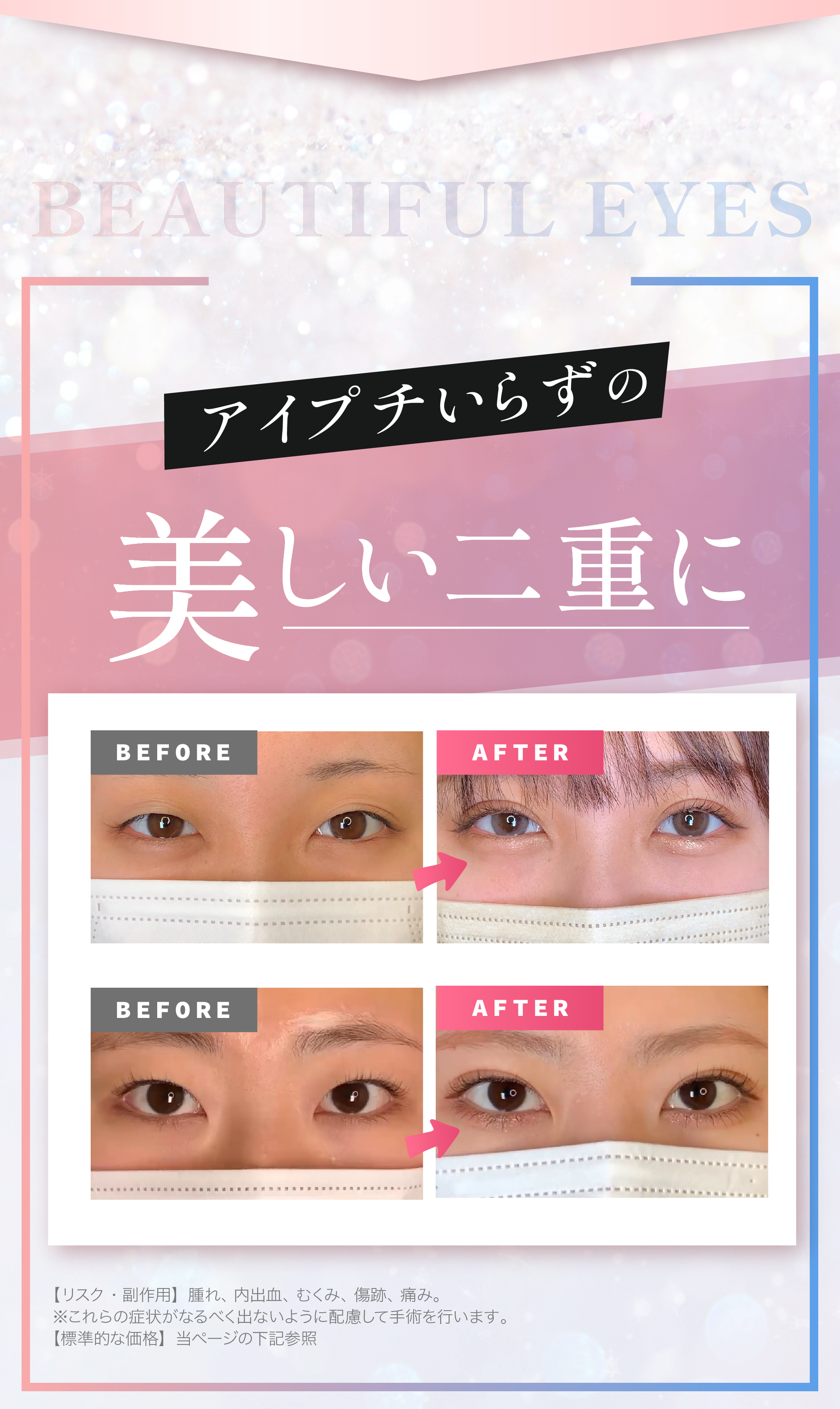 アイプチ入らずの二重