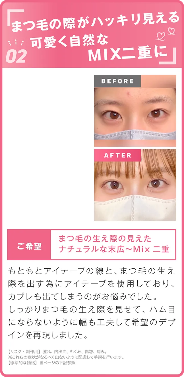 可愛く自然な二重へ