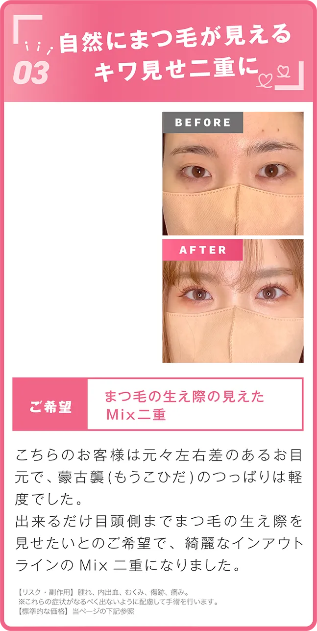 キワ見せ二重へ