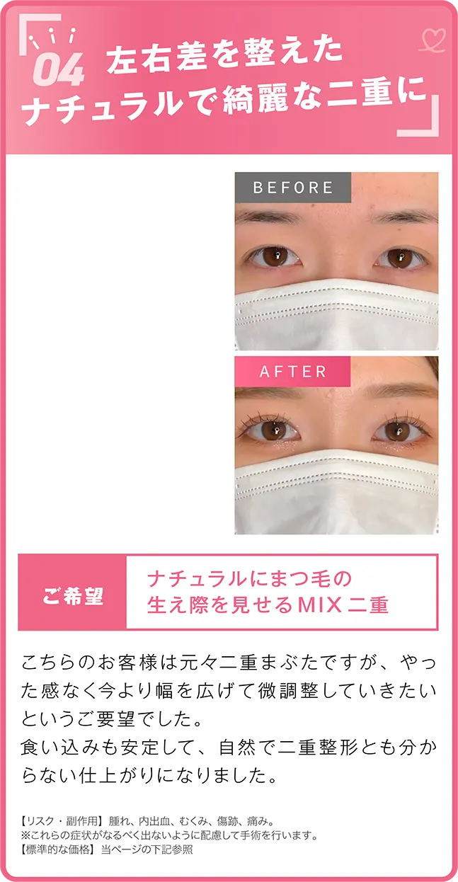 悩んでいた奥二重から自然なクッキリ二重に