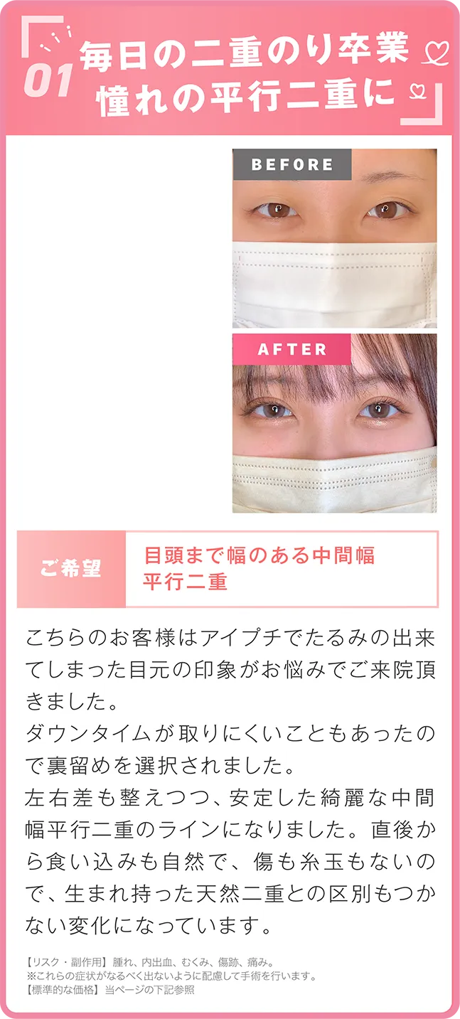 悩憧れの平行二重に