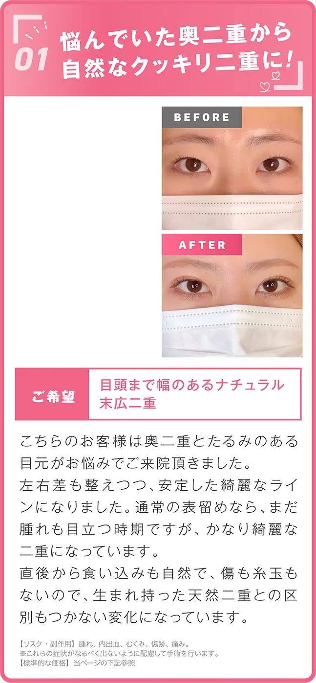 悩んでいた奥二重から自然なクッキリ二重に