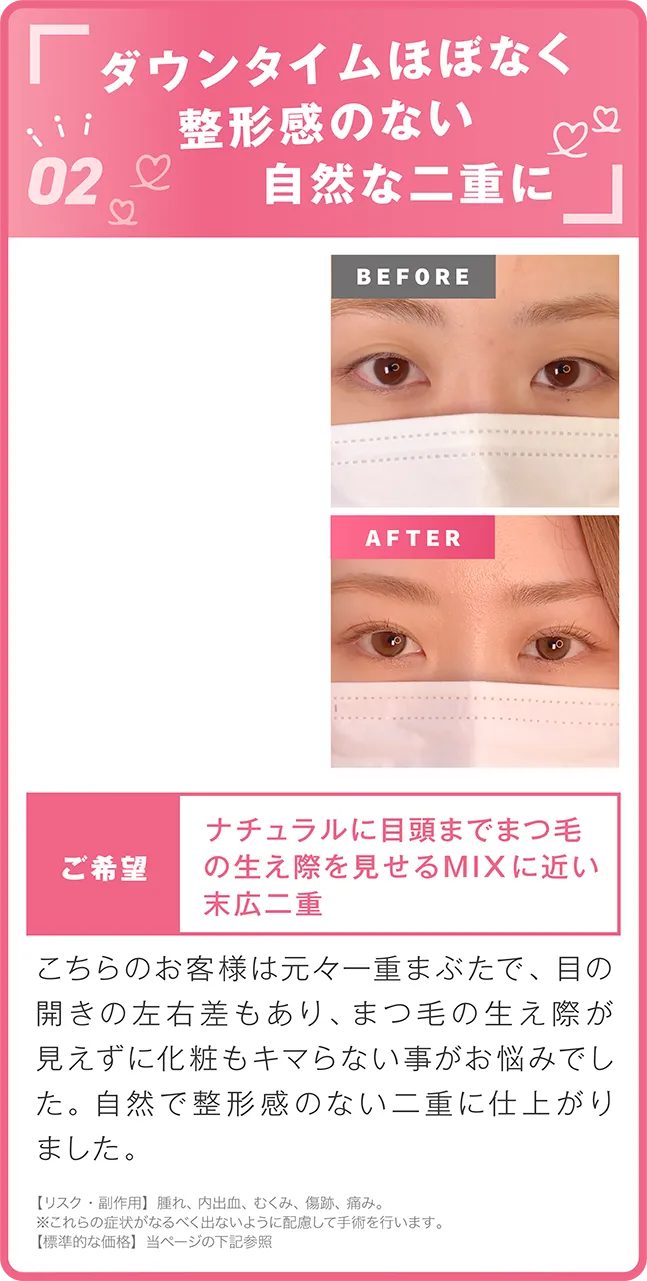 整形感のない自然な二重へ