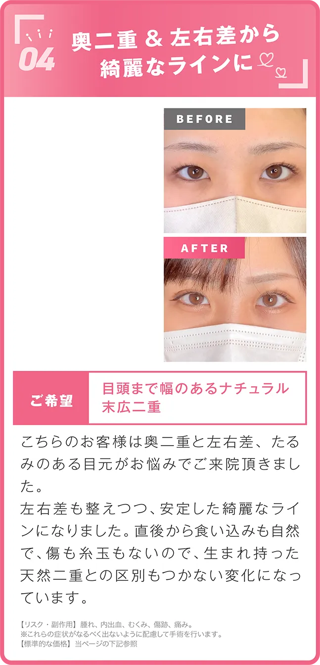 悩んでいた奥二重から自然なクッキリ二重に