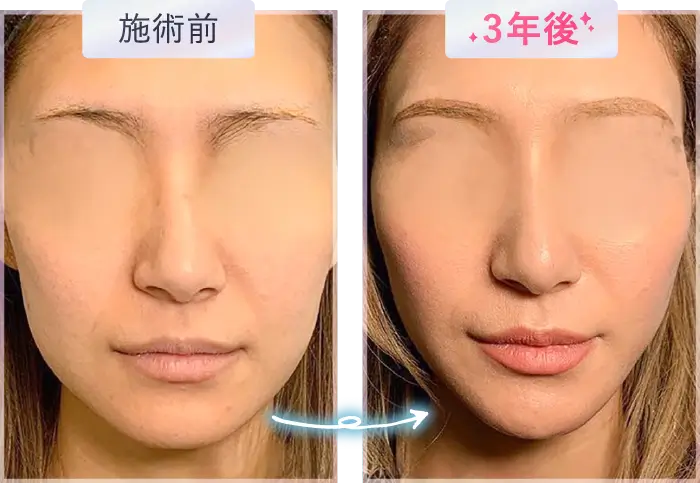 施術前/3年後